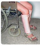 Picture of Protective Leg Tube DermaSaver™ Medium081509033