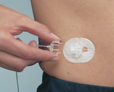 Picture of Insulin Infusion Set Silhouette®Paradigm® 17 mm 43 Inch Tubing Without PortMMT-371