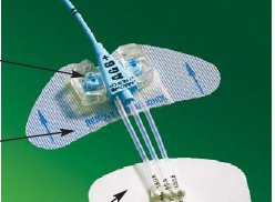 Picture of Central Venous Catheter Stabilization Device StatLock® CV PlusCV0226