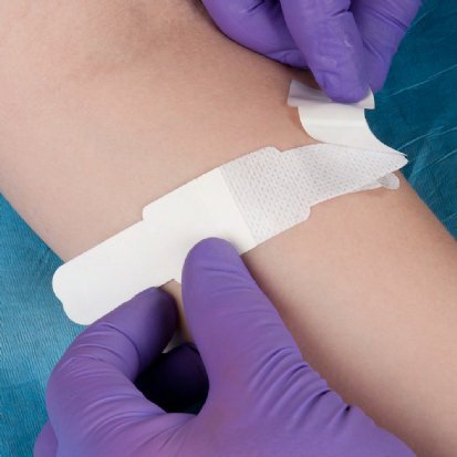 Picture of Dialysis Fistula Needle Grip-Lok®3500DFN