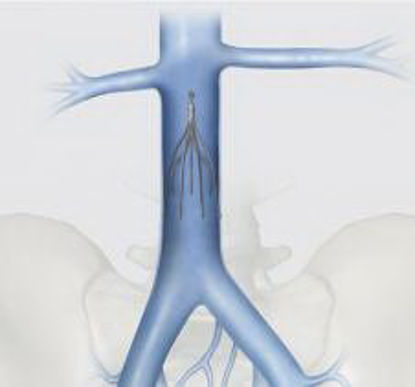 Picture of Platinum Vena Cava Filter CelectG34502