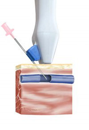 Picture of Needle Guide Kit 21 Gauge, 48 Inch L Probe Cover900013B01