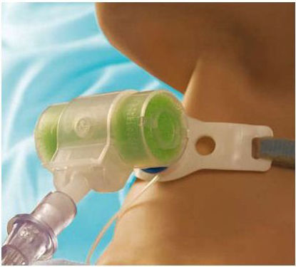 Picture of Tracheostomy Tube Hydro-Trach T Mk II HME1873030