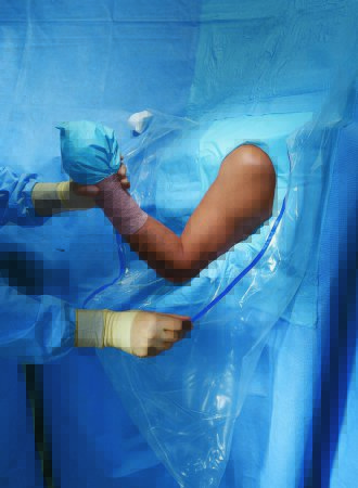 Picture of Orthopedic Drape Shoulder Arthroscopy Drape 160 W X 102 L Inch Sterile89070