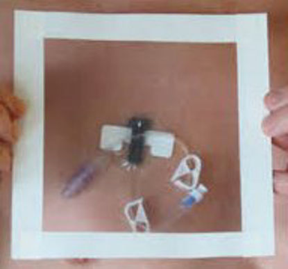 Picture of Wound Protector HydroSeal TabsHS5X5