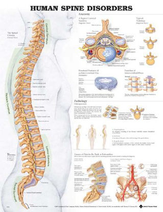 Picture of Anatomical Chart Human Spine Disorders 20 X 26 Inch Plastic Wall Mount Laminated9781587794438