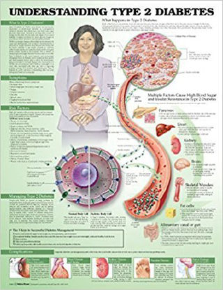 Picture of Anatomical Chart Type 2 Diabetes 20 X 26 Inch Heavy Paper Grommets Laminated9781469894980