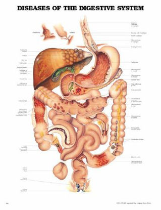 Picture of Anatomical Chart Diseases of the Digestive System 20 X 26 Inch Plastic Wall Mount Laminated9781587792366