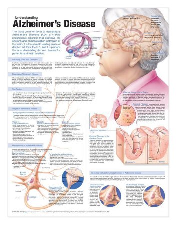 Picture of Anatomical Chart Alzheimer's Disease 20 X 26 Inch Heavy Paper Grommets Laminated9780781786331