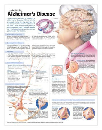 Picture of Anatomical Chart Alzheimer's Disease 20 X 26 Inch Heavy Paper Grommets Laminated9780781786331