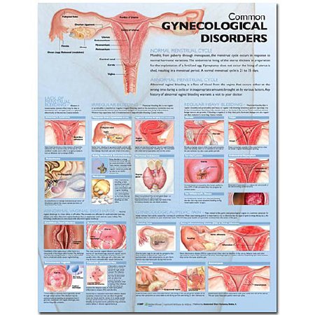 Picture of Anatomical Chart Common Gynecological Disorders 20 X 26 Inch Paper Grommets Laminated9780781773508