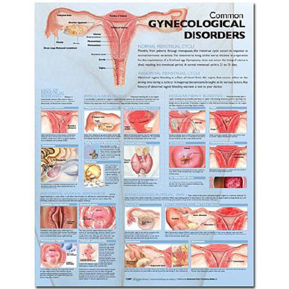 Picture of Anatomical Chart Common Gynecological Disorders 20 X 26 Inch Paper Grommets Laminated9780781773508