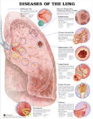 Picture of Anatomical Chart Lung Diseases 20 X 26 Inch Heavy Paper Grommets Laminated9781587799082