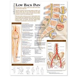 Picture of Anatomical Chart Understanding Low Back Pain 20 X 26 Inch Heavy Paper Grommets Laminated9780781782432