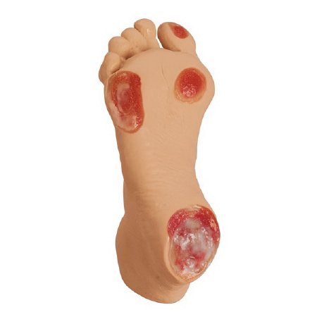 Picture of Pressure Ulcer Foot Model Life/Form® Adult - Geriatric 2-1/5 lbs.LF00933