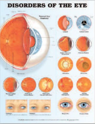 Picture of Anatomical Chart Eye Disorder 20 X 26 Inch Heavy Paper Grommets Laminated9781587799259