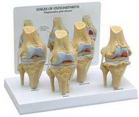 Picture of 4 Stage Osteoarthritis Knee Model GPI Anatomicals70573