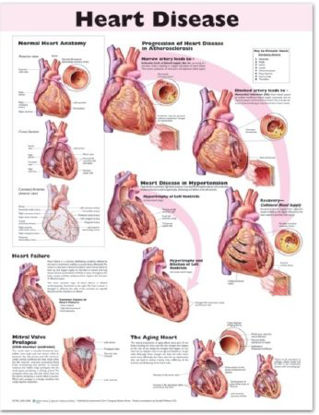 Picture of Anatomical Chart Heart Disease 20 X 26 Inch Heavy Paper Grommets Laminated9780781773386