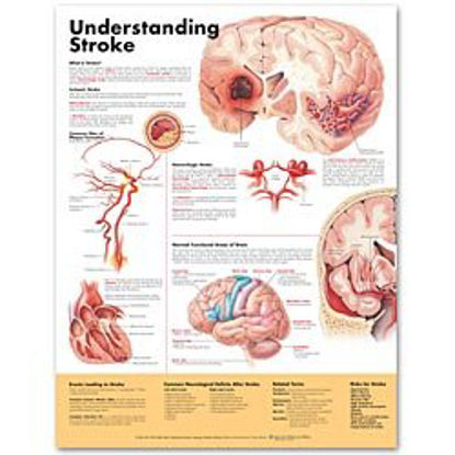Picture of Anatomical Chart Understanding Stroke 20 X 26 Inch Heavy Paper Grommets Laminated9781587799884