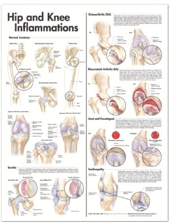 Picture of Anatomical Chart Hip and Knee 20 X 26 Inch Heavy Paper Grommets Laminated9780781773478