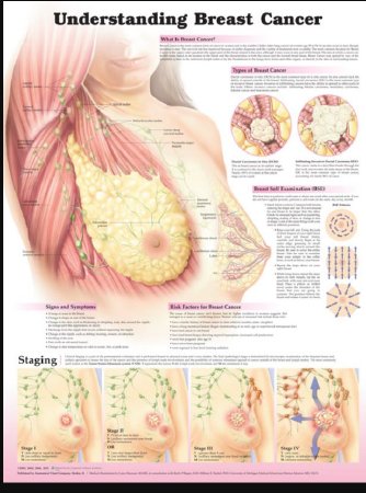Picture of Anatomical Chart Breast Cancer 20 X 26 Inch Heavy Paper Grommets Laminated9781451185652