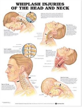 Picture of Anatomical Chart Anatomical Chart Co Whiplash Injuries of the Head and Neck9781587793769