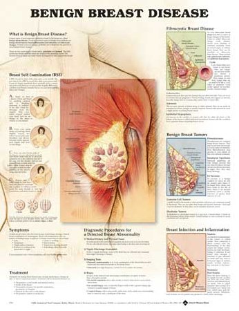 Picture of Anatomical Chart Benign Breast Disease 20 X 26 Inch Heavy Paper Grommets Laminated9781587796746
