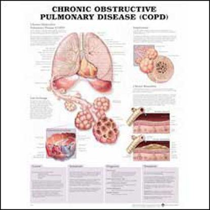 Picture of Anatomical Chart Chronic Obstructive Pulmonary Disease 20 X 26 Inch Plastic Wall Mount Laminated9780781782371