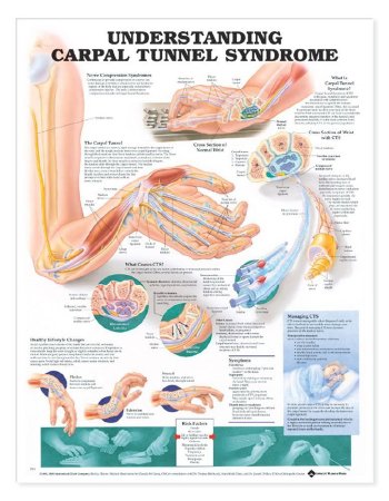 Picture of Anatomical Chart Carpal Tunnel Syndrome 20 X 26 Inch Heavy Paper Grommets Laminated9781587793226