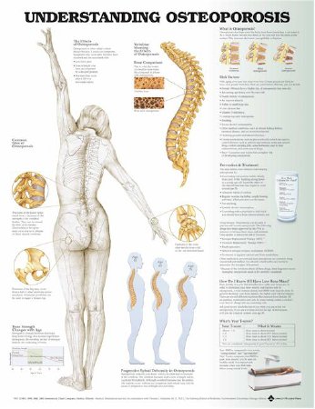 Picture of Anatomical Chart Understanding Osteoporosis 20 X 26 Inch Plastic Grommets Laminated9781496362483