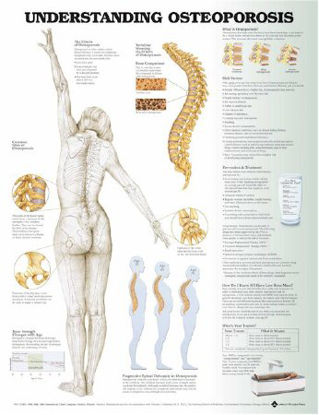 Picture of Anatomical Chart Understanding Osteoporosis 20 X 26 Inch Plastic Grommets Laminated9781496362483
