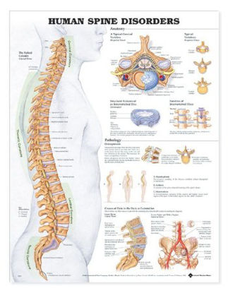 Picture of Anatomical Chart Spine Disorders 20 X 26 Inch Heavy Paper Grommets Laminated9781587793998
