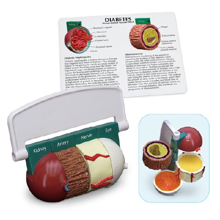 Picture of Diabetes ModelWA29777