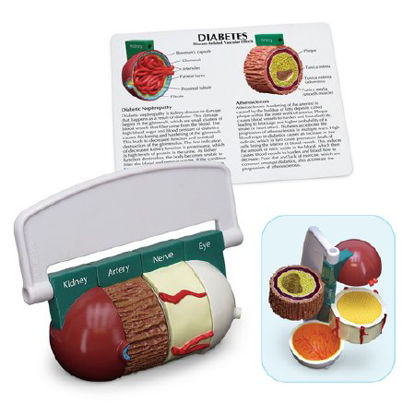 Picture of Diabetes ModelWA29777