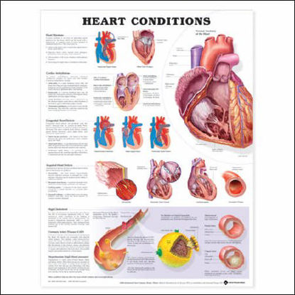 Picture of Anatomical Chart Heart Conditions 20 X 26 Inch Heavy Paper Laminated9781587798832