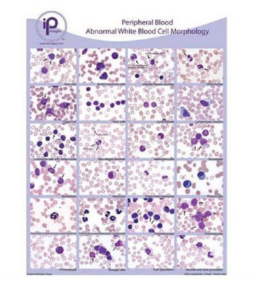 Picture of Anatomical Chart Blood Abnormal WBC Morphology Laminated7813