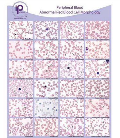 Picture of Anatomical Chart Blood Abnormal Red Blood Cell (RBC) Morphology Laminated7812