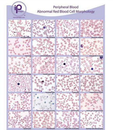 Picture of Anatomical Chart Blood Abnormal Red Blood Cell (RBC) Morphology Laminated7812