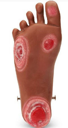 Picture of ULCER, FOOT GERI/KERI MED SKINLF04128