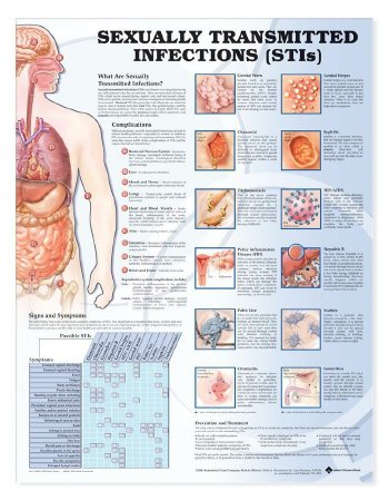 Picture of Anatomical Chart Sexually Transmitted Infections (STIS) 20 X 26 Inch Heavy Paper Grommets Laminated9781587798498