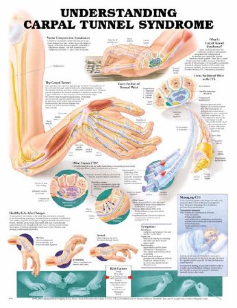 Picture of Anatomical Chart Understanding Carpal Tunnel Syndrome 20 X 26 Inch Heavy Paper Grommets Laminated9781587793219