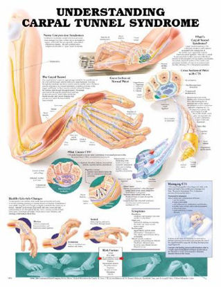 Picture of Anatomical Chart Understanding Carpal Tunnel Syndrome 20 X 26 Inch Heavy Paper Grommets Laminated9781587793219