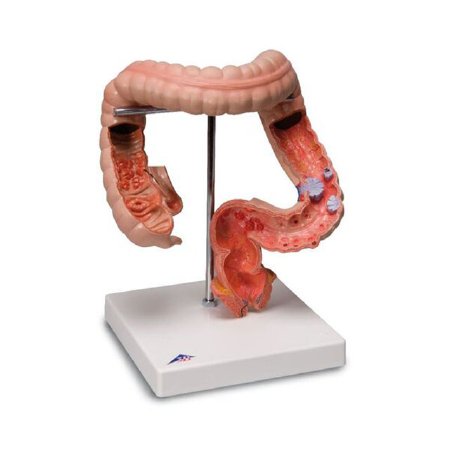 Picture of Intestinal Diseases Model 3B Scientific® 2.11 lbs.Z02807