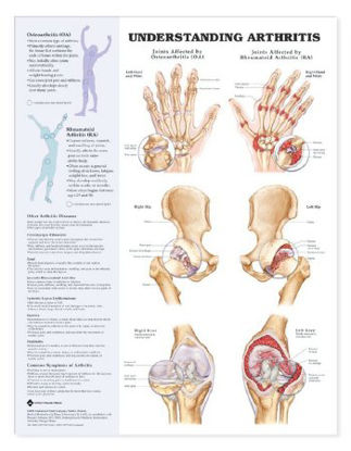 Picture of Anatomical Chart Arthritis 20 X 26 Inch Heavy Paper Grommets Laminated9781587793851