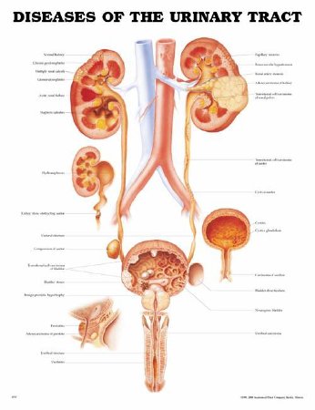 Picture of Anatomical Chart Diseases of the Urinary Tract 20 X 26 Inch Plastic Grommets Laminated9781587792410