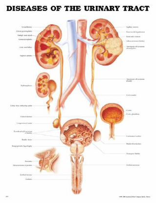 Picture of Anatomical Chart Diseases of the Urinary Tract 20 X 26 Inch Plastic Grommets Laminated9781587792410