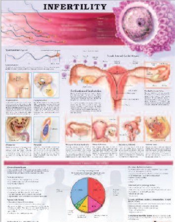 Picture of Anatomical Chart Infertility 20 X 26 Inch Heavy Paper Grommets Laminated9781587798597