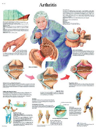 Picture of Anatomical Chart Arthritis 20 X 26 Inch Laminated12-4605L