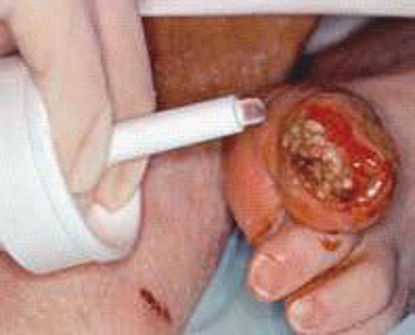 Picture of Hydrogel Dressing Intrasite 15 gm66027311