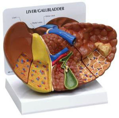 Picture of Liver Pathology Model GPI Anaotomicals810980